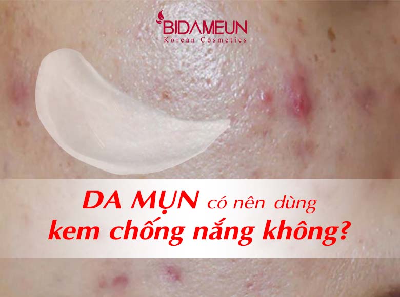 Da mụn có nên dùng kem chống nắng không?