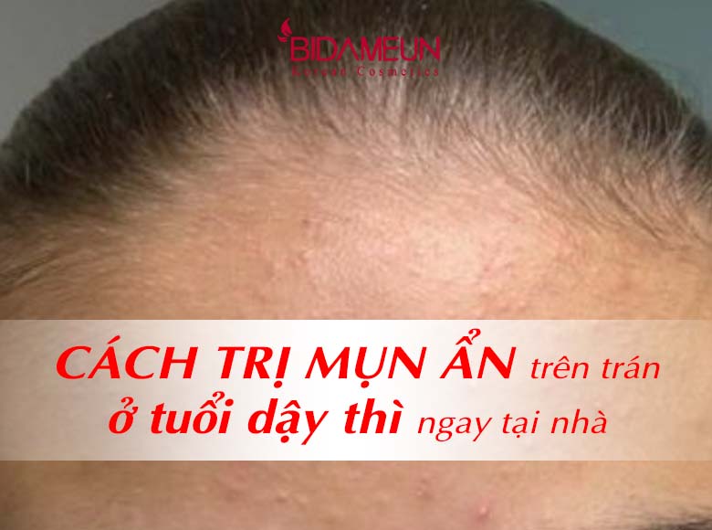 Cách trị mụn ẩn trên trán ở tuổi dậy thì ngay tại nhà