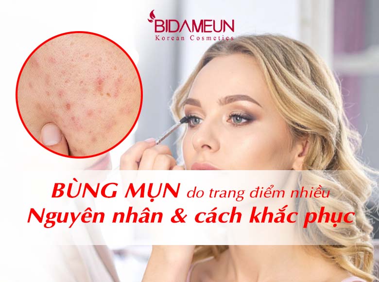 Bùng mụn do trang điểm nhiều: Nguyên nhân và cách khắc phục