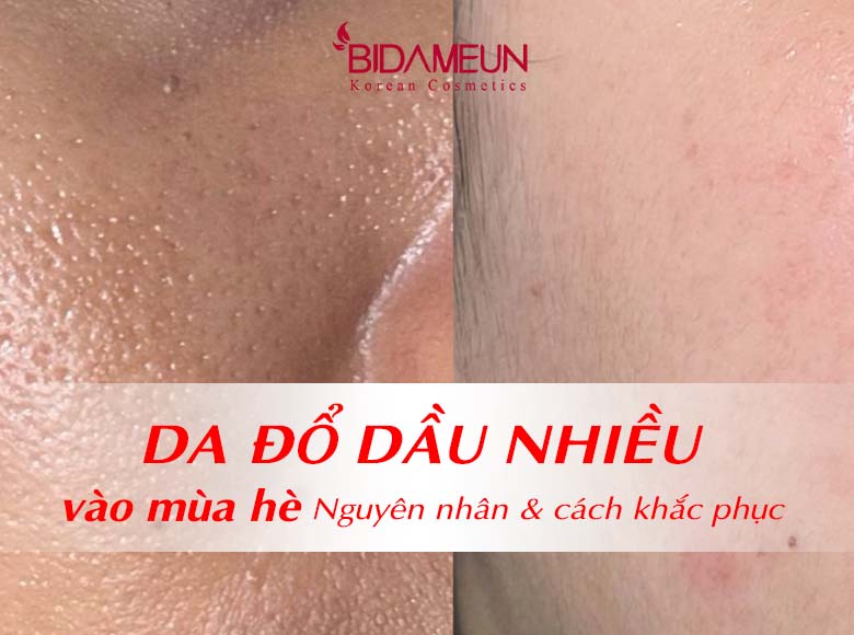 Da đổ dầu nhiều vào mùa hè:  Nguyên nhân và cách khắc phục